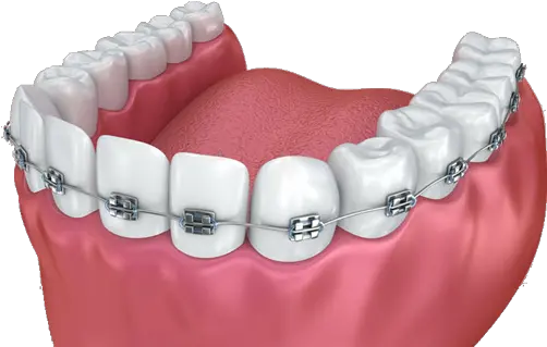 Download Braces Dental Implant Png Braces Png