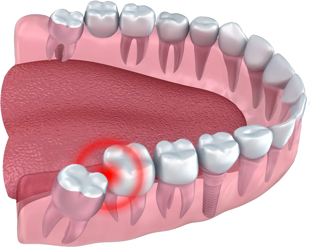 Wisdom Teeth Removal Cardinia Dental Teeth With Wisdom Teeth Png Teeth Png