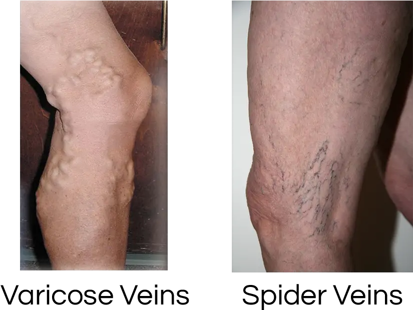 Vein Disorders Specialists Of Spider Veins Png Veins Png