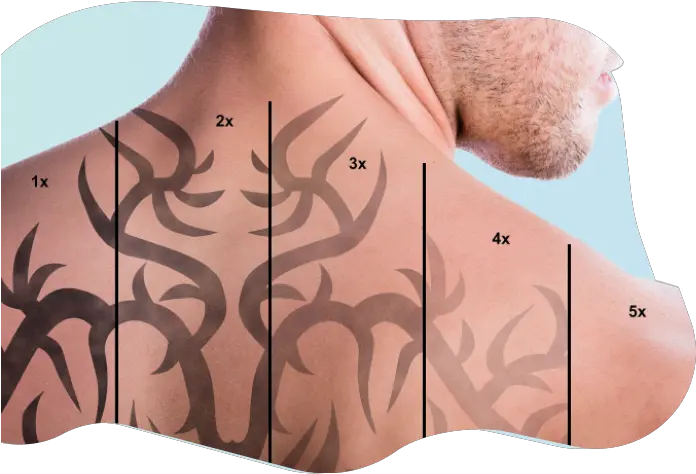 Laser Tattoo Removal In Dubai Eyebrow Laser Tattoo Removal Body Png Chest Tattoo Png