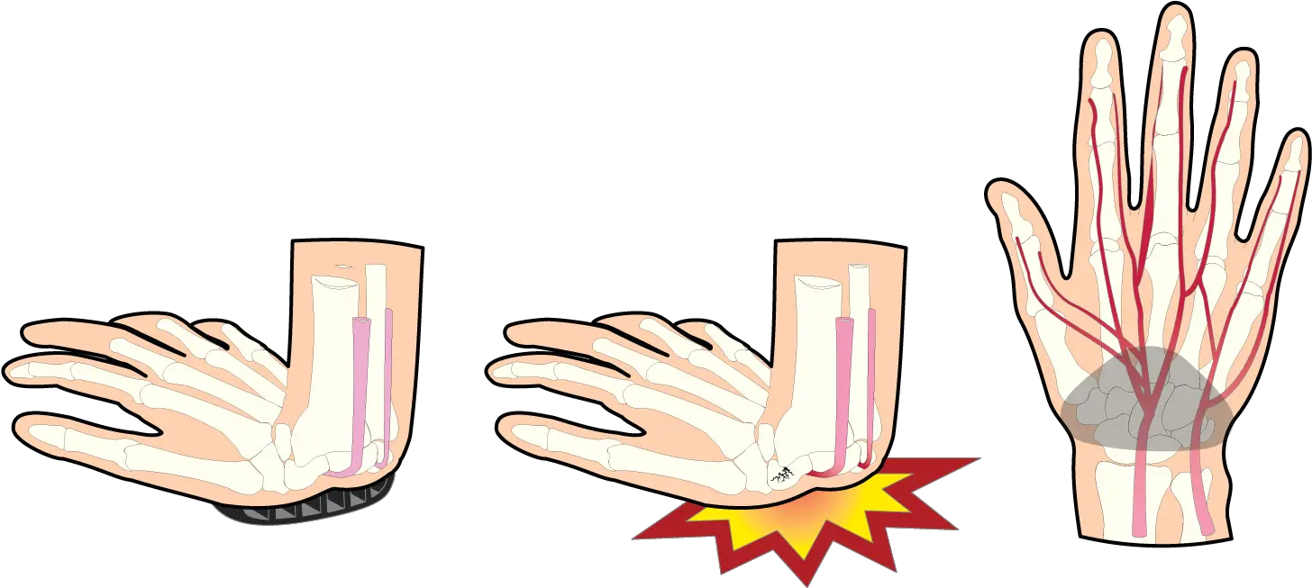 Legs Clipart Bruised Transparent Free For Sign Language Png Bruise Transparent