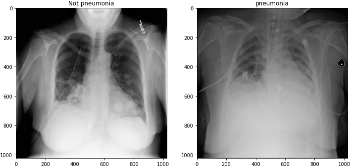 Deep Learning For Detecting Pneumonia From X Ray Images Pneumonia Vs Normal Chest X Ray Png X Ray Png