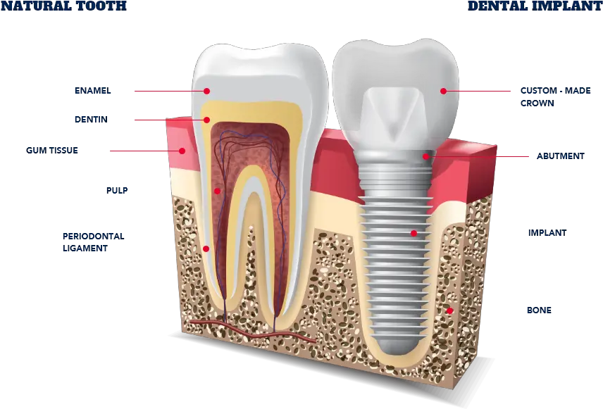 Dental Implants Types Getting New Teeth All Dental Implants In Jawbone Png Star Crown Png