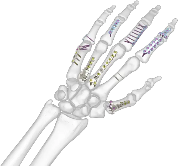 Hand Implants For Doctors And Hand Bones Png Skeleton Hand Png