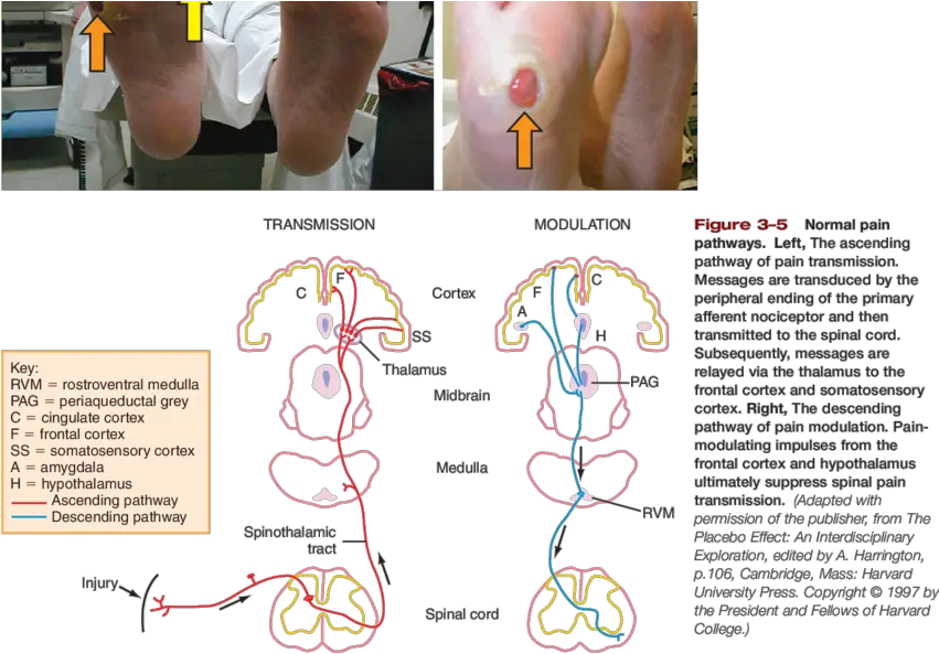 Photos Of Claw Toes Foot Deformity Green Arrow Diagram Png Orange Arrow Png