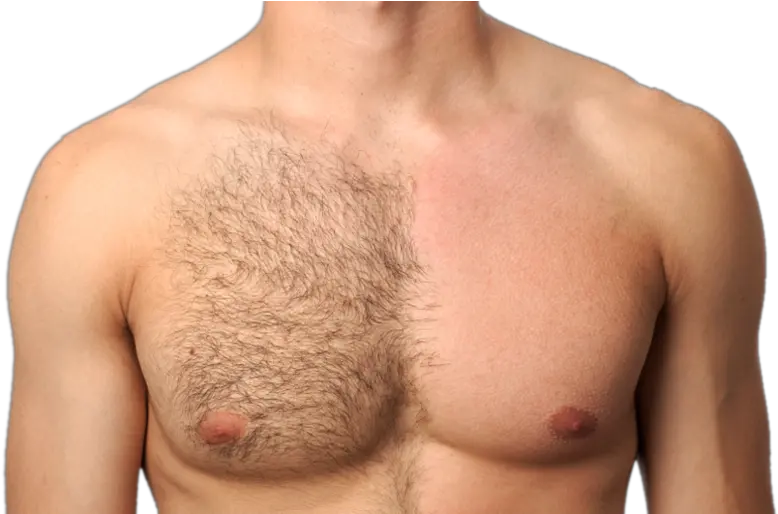 Best Hair Reduction Treatment In Bangalore And Hyderabad Men Trimming Body Hair Png Chest Hair Png