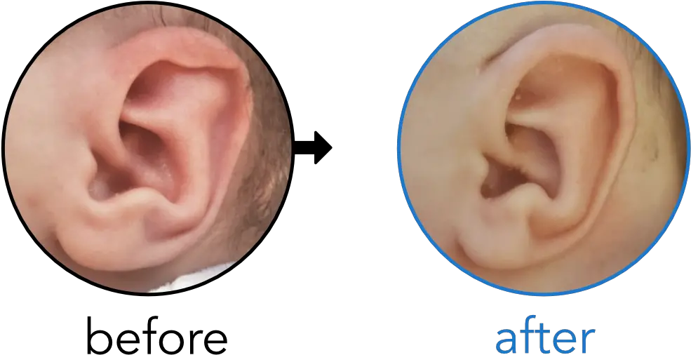 Before U0026 Afters Earbuddies Permanent Solution To Stick My Ears Stick Out Png Elf Ear Png