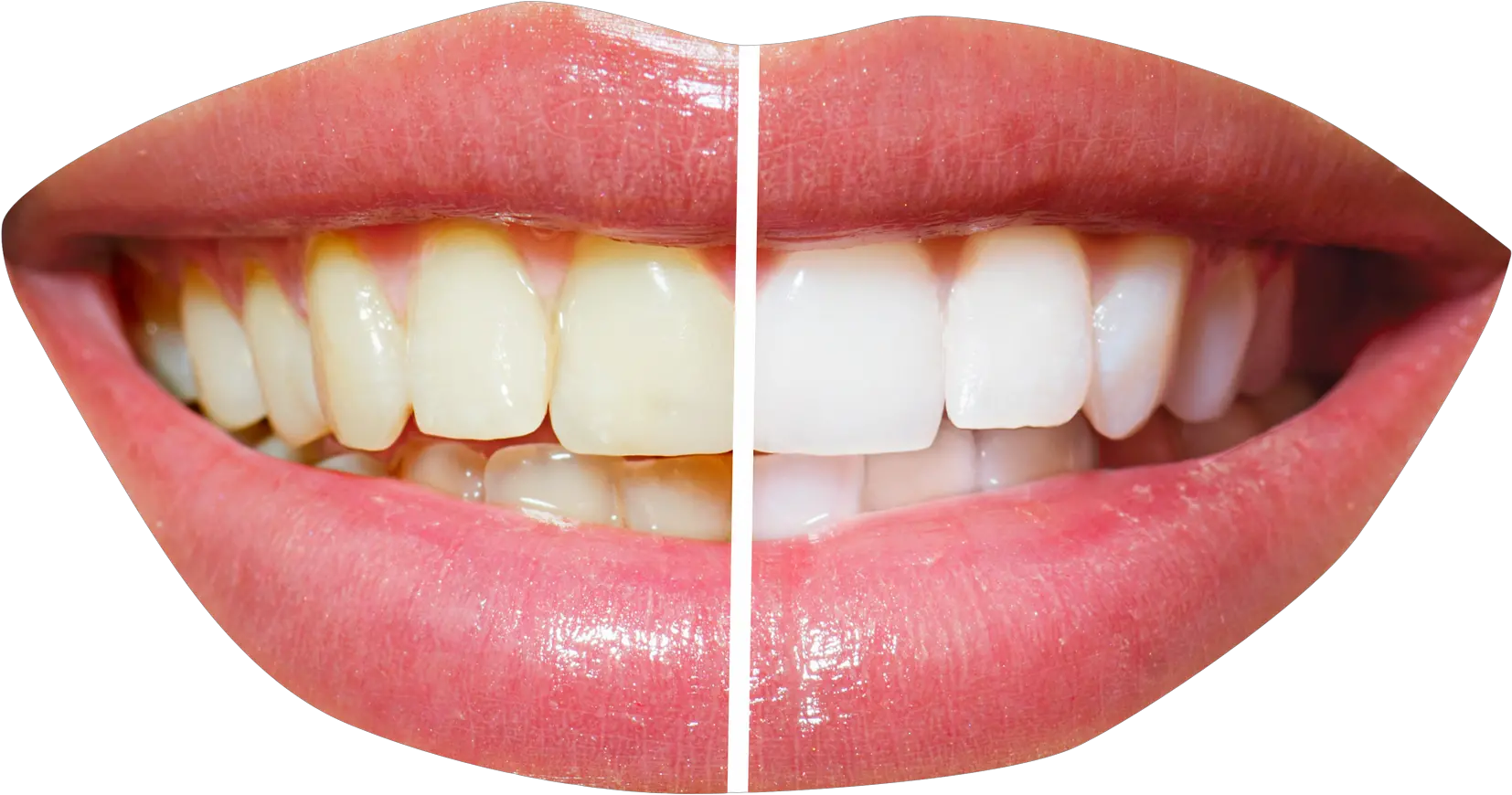 Teeth File Png Transparent Background Teeth Before And After Cleaning Teeth Png